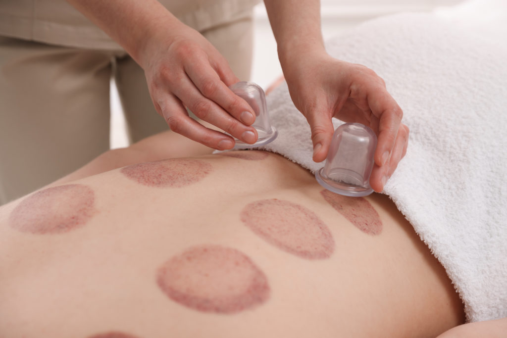 terapia con ventosa cupping Burriana Castellón